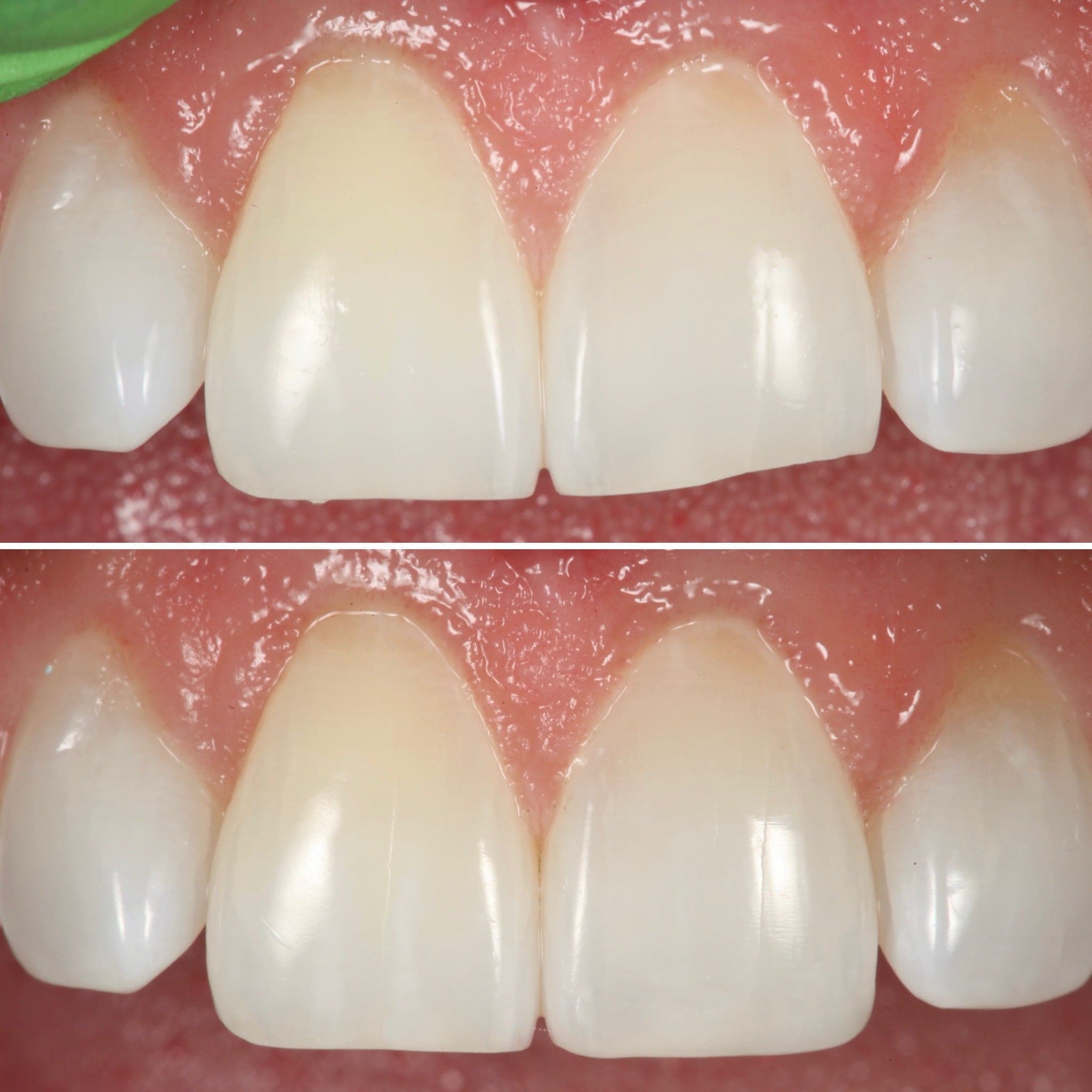 Composite bonding to close a midline gap — before and after, Strupp & Brumm, Clearwater FL