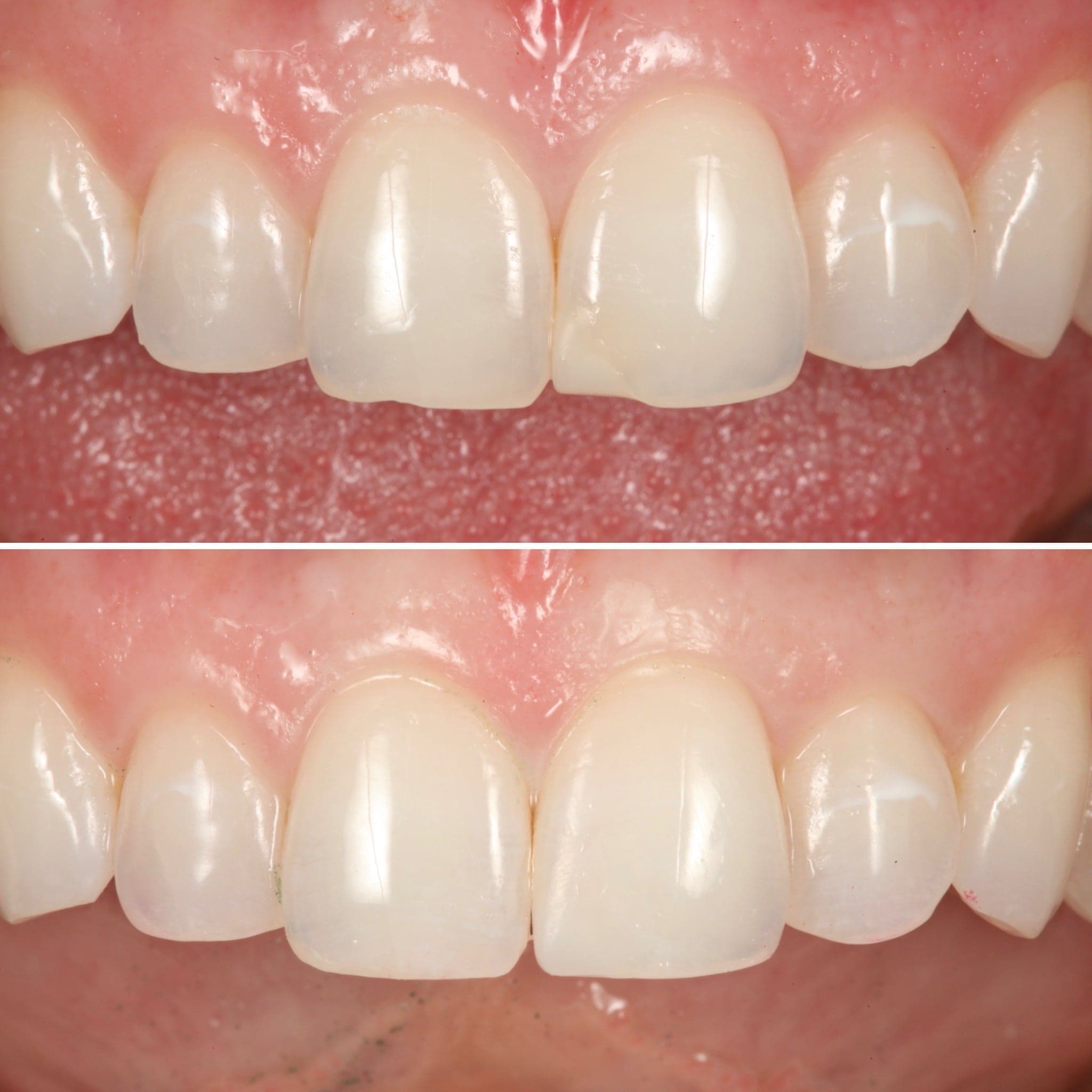 Direct composite bonding — before and after by Strupp & Brumm, Clearwater FL