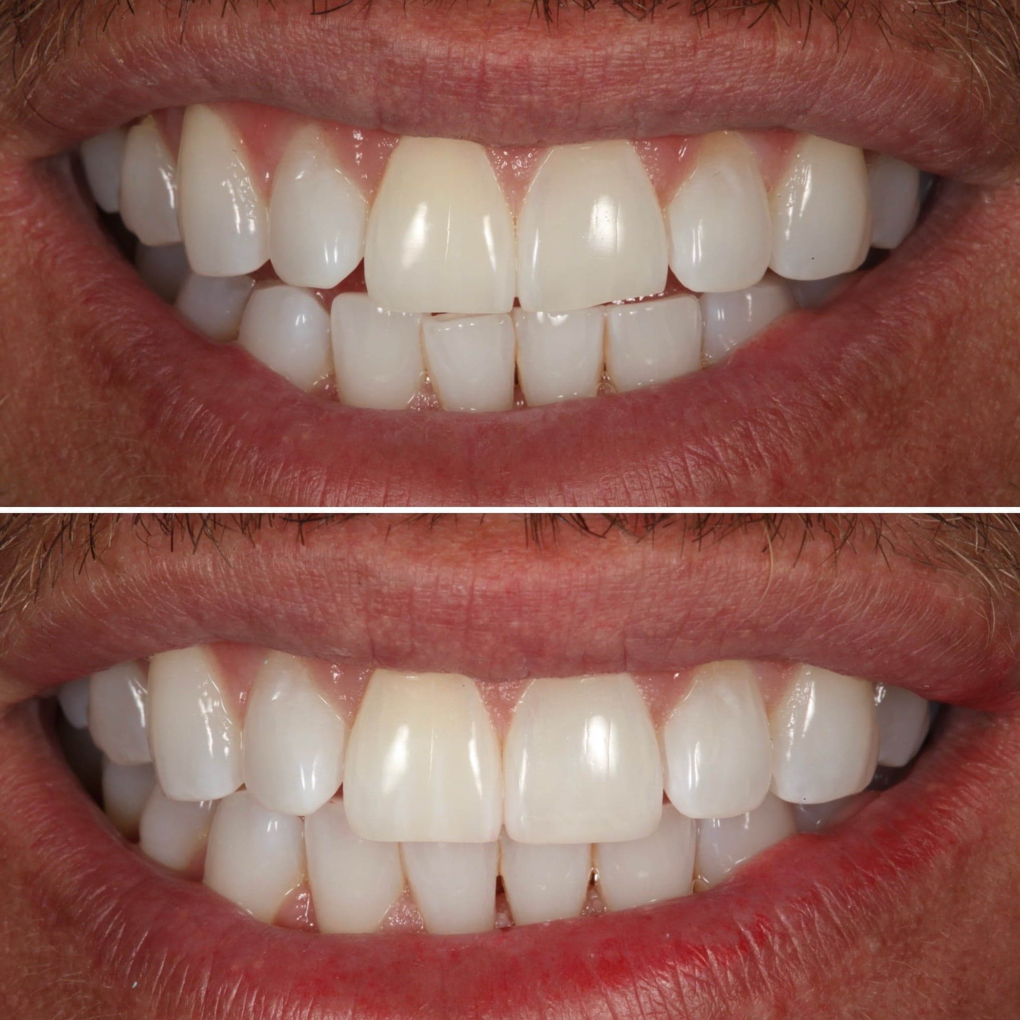 Direct composite bonding — before and after by Strupp & Brumm, Clearwater FL