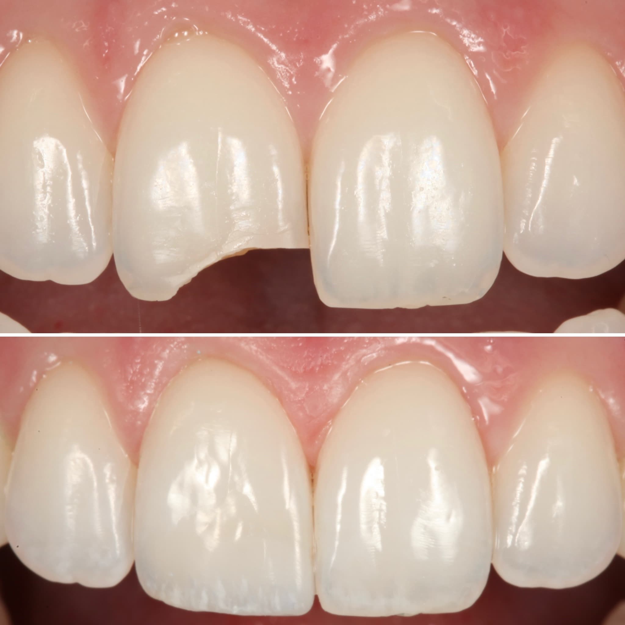 Direct composite bonding — before and after by Strupp & Brumm, Clearwater FL