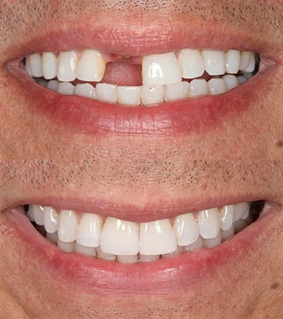 Before and after — Cosmetic & restorative dentistry — case 10 by Strupp & Brumm in Clearwater, FL