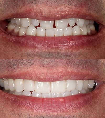 Before and after — Cosmetic & restorative dentistry — case 11 by Strupp & Brumm in Clearwater, FL