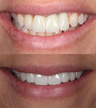Before and after — Cosmetic & restorative dentistry — case 13 by Strupp & Brumm in Clearwater, FL