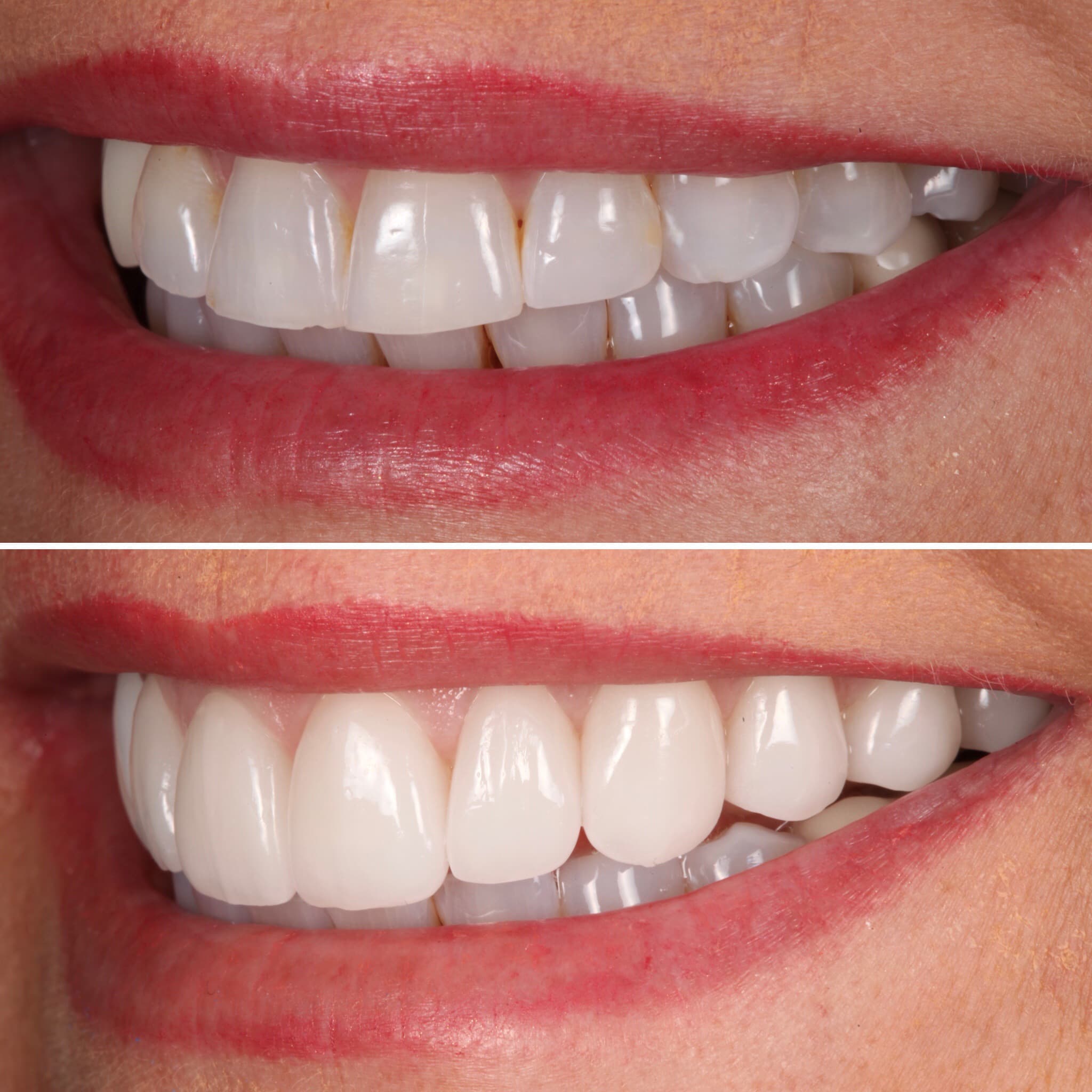Porcelain Veneers at Strupp & Brumm, Clearwater FL