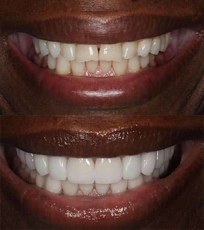 Before and after — Cosmetic & restorative dentistry — case 18 by Strupp & Brumm in Clearwater, FL