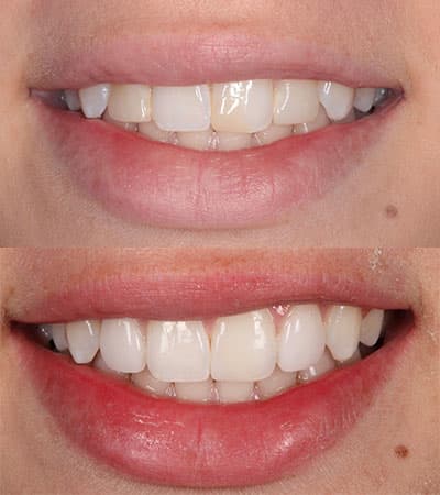 Before and after — Cosmetic & restorative dentistry — case 2 by Strupp & Brumm in Clearwater, FL