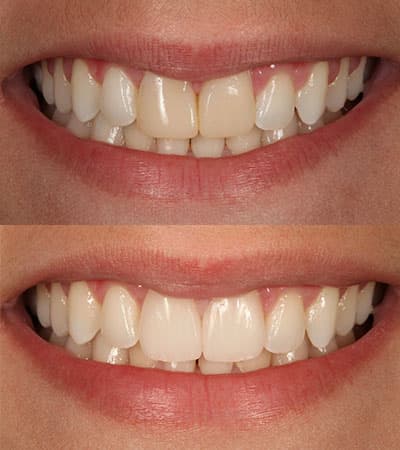 Before and after — Cosmetic & restorative dentistry — case 20 by Strupp & Brumm in Clearwater, FL