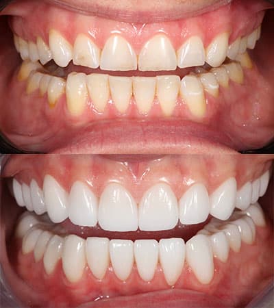 Before and after — Cosmetic & restorative dentistry — case 24 by Strupp & Brumm in Clearwater, FL