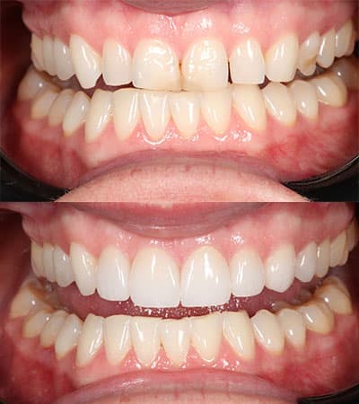 Before and after — Cosmetic & restorative dentistry — case 26 by Strupp & Brumm in Clearwater, FL