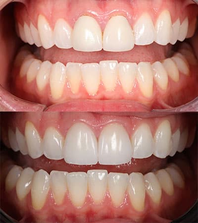 Before and after — Cosmetic & restorative dentistry — case 27 by Strupp & Brumm in Clearwater, FL