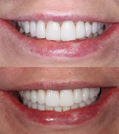 Before and after — Cosmetic & restorative dentistry — case 29 by Strupp & Brumm in Clearwater, FL
