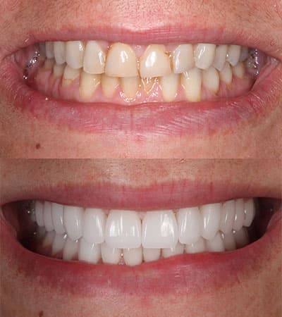 Before and after — Cosmetic & restorative dentistry — case 3 by Strupp & Brumm in Clearwater, FL