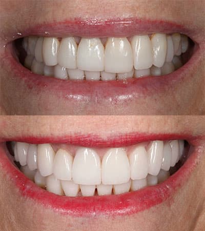 Before and after — Cosmetic & restorative dentistry — case 31 by Strupp & Brumm in Clearwater, FL