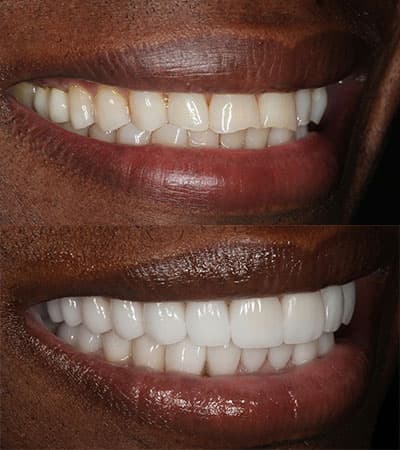 Before and after — Cosmetic & restorative dentistry — case 32 by Strupp & Brumm in Clearwater, FL
