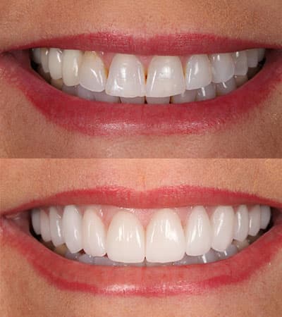Before and after — Cosmetic & restorative dentistry — case 34 by Strupp & Brumm in Clearwater, FL