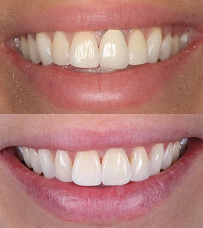 Before and after — Cosmetic & restorative dentistry — case 35 by Strupp & Brumm in Clearwater, FL