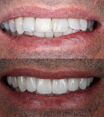 Before and after — Cosmetic & restorative dentistry — case 36 by Strupp & Brumm in Clearwater, FL