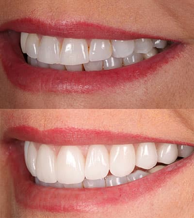 Before and after — Cosmetic & restorative dentistry — case 4 by Strupp & Brumm in Clearwater, FL