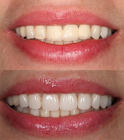 Before and after — Cosmetic & restorative dentistry — case 40 by Strupp & Brumm in Clearwater, FL