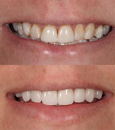 Before and after — Cosmetic & restorative dentistry — case 43 by Strupp & Brumm in Clearwater, FL