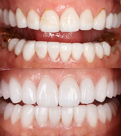 Before and after — Cosmetic & restorative dentistry — case 45 by Strupp & Brumm in Clearwater, FL