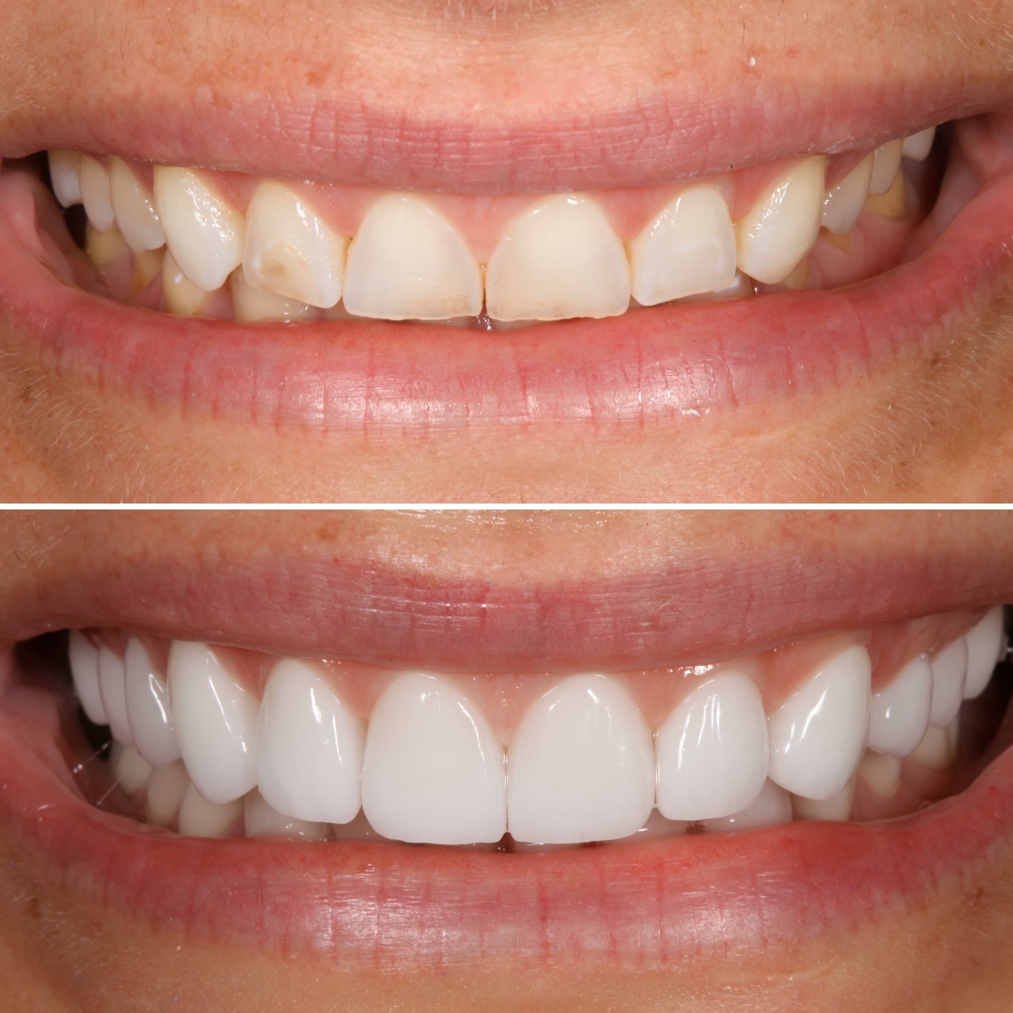 Before and after — Cosmetic & restorative dentistry — case 46 by Strupp & Brumm in Clearwater, FL
