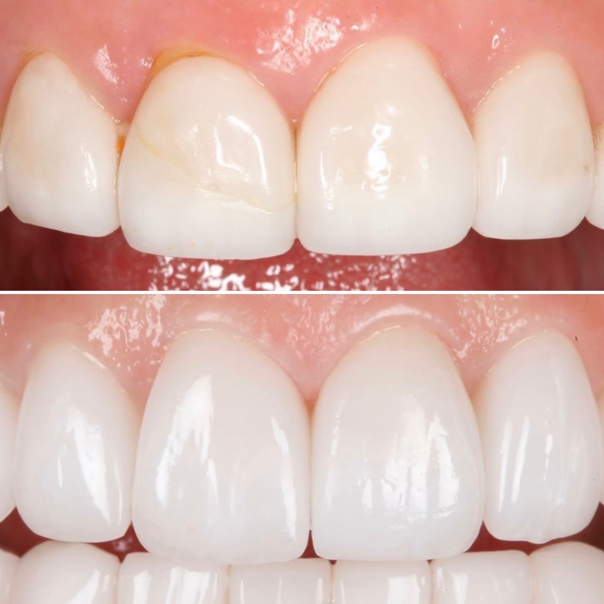 Before and after — Cosmetic & restorative dentistry — case 48 by Strupp & Brumm in Clearwater, FL