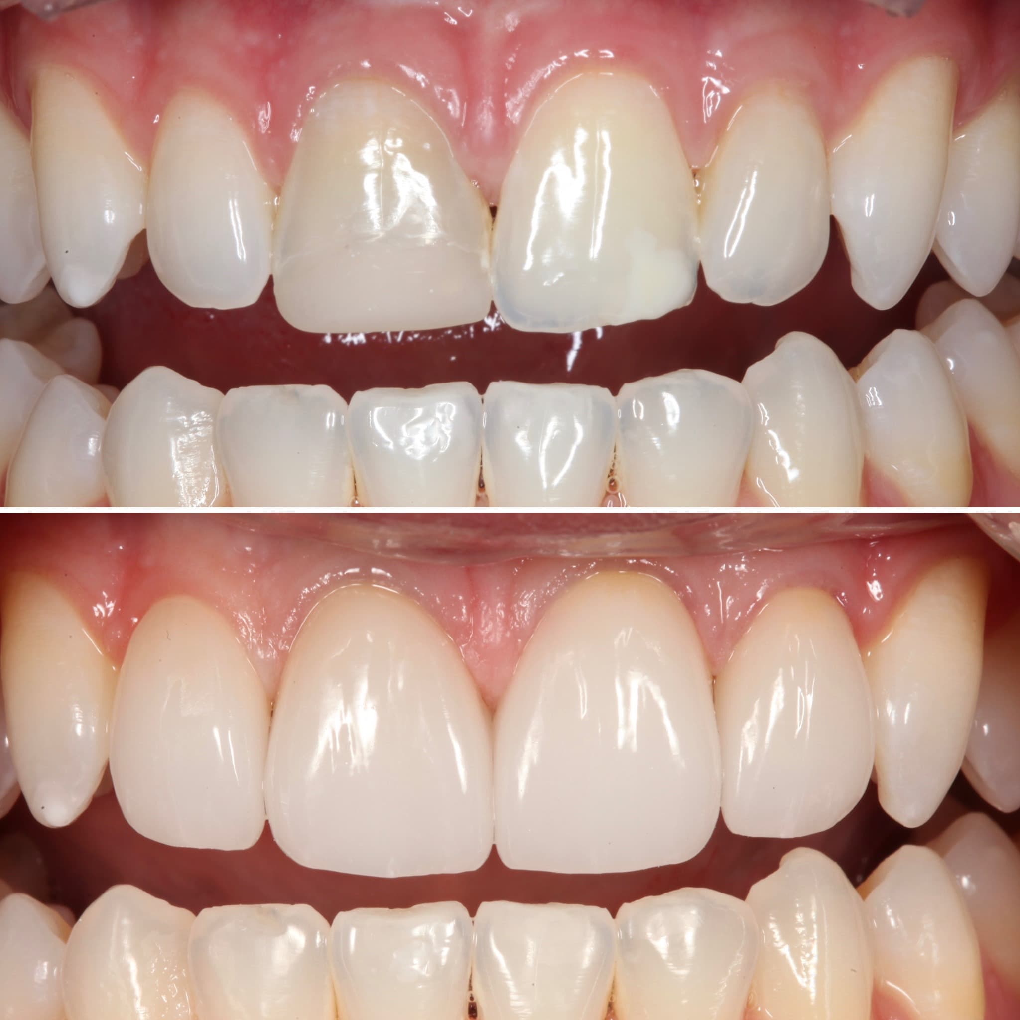 Before and after — Cosmetic & restorative dentistry — case 51 by Strupp & Brumm in Clearwater, FL
