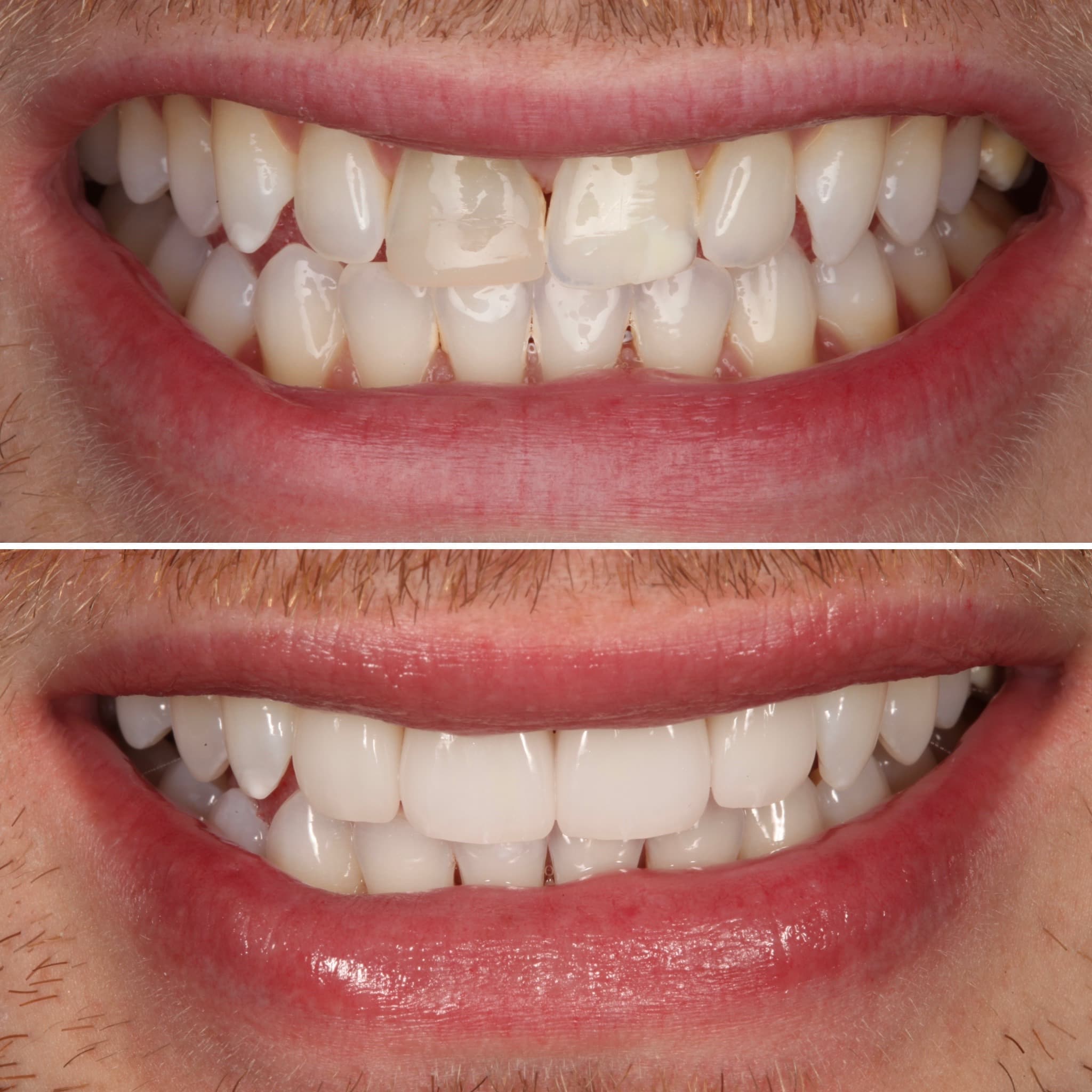 Before and after — Cosmetic & restorative dentistry — case 53 by Strupp & Brumm in Clearwater, FL