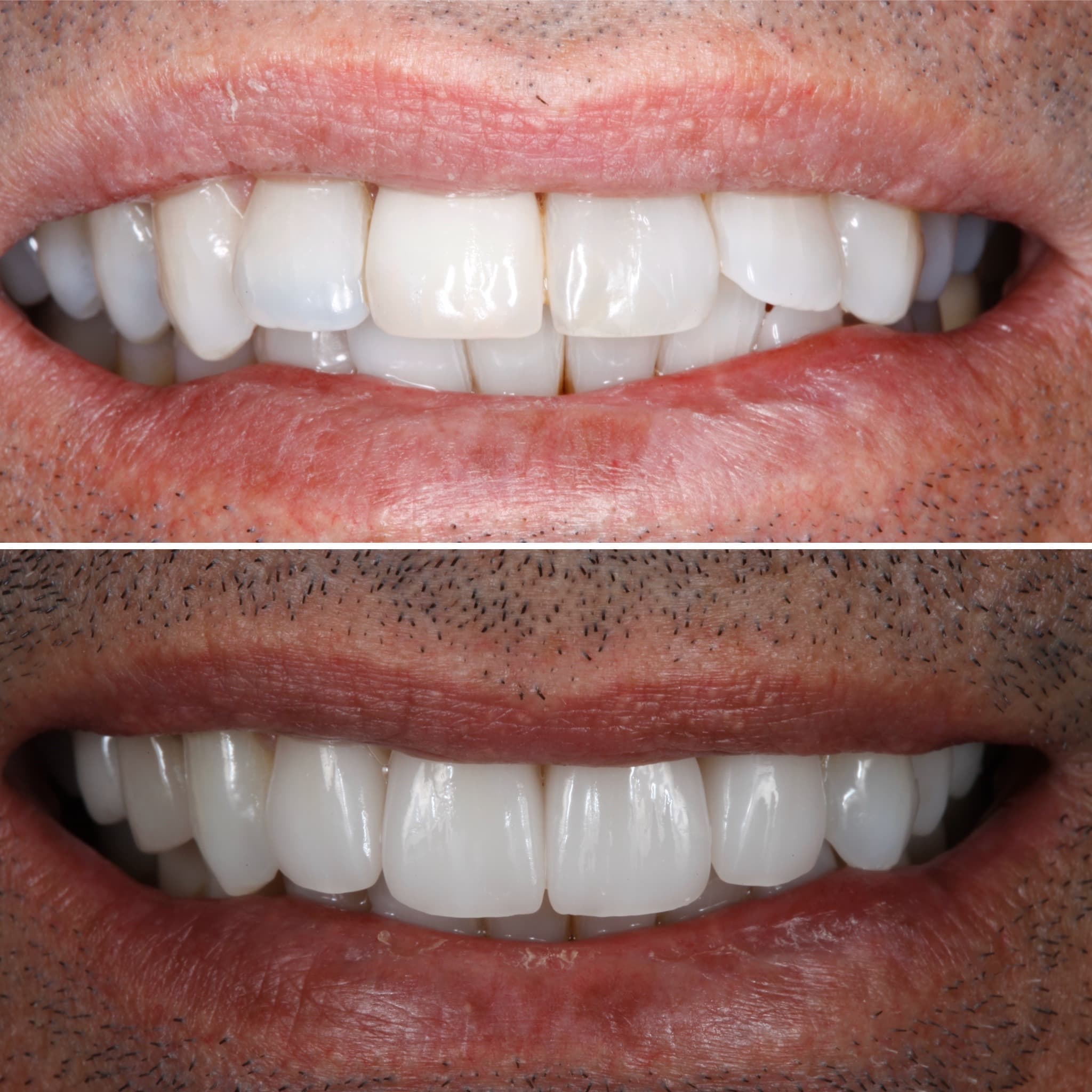 Before and after — Cosmetic & restorative dentistry — case 54 by Strupp & Brumm in Clearwater, FL
