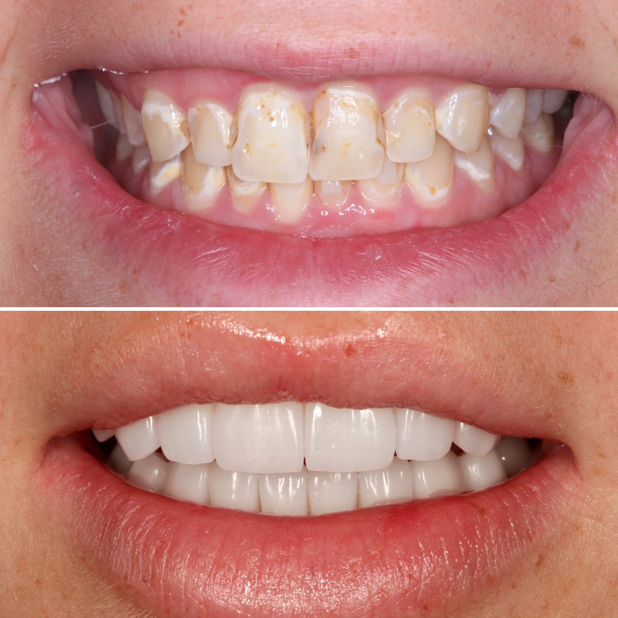 Before and after — Cosmetic & restorative dentistry — case 55 by Strupp & Brumm in Clearwater, FL