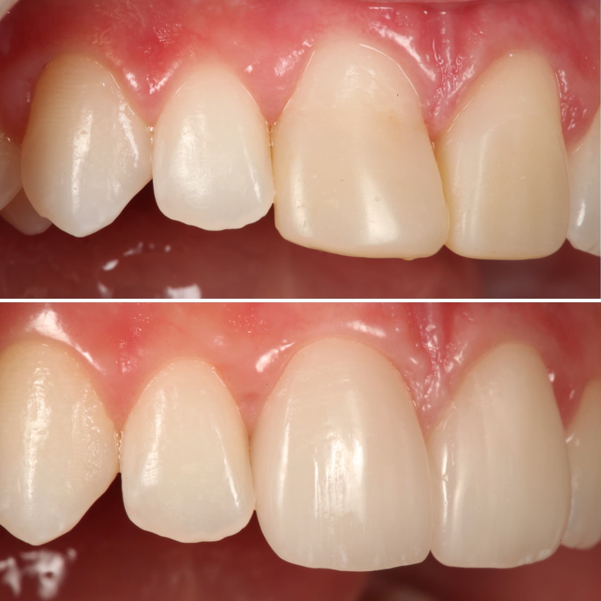 Before and after — Cosmetic & restorative dentistry — case 56 by Strupp & Brumm in Clearwater, FL