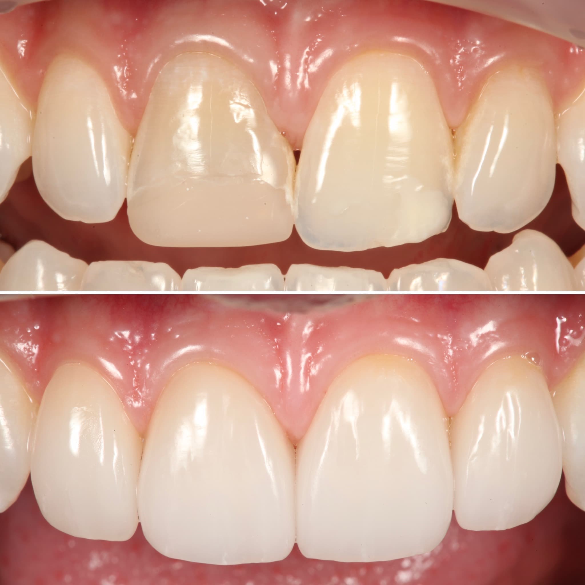 Before and after — Cosmetic & restorative dentistry — case 57 by Strupp & Brumm in Clearwater, FL