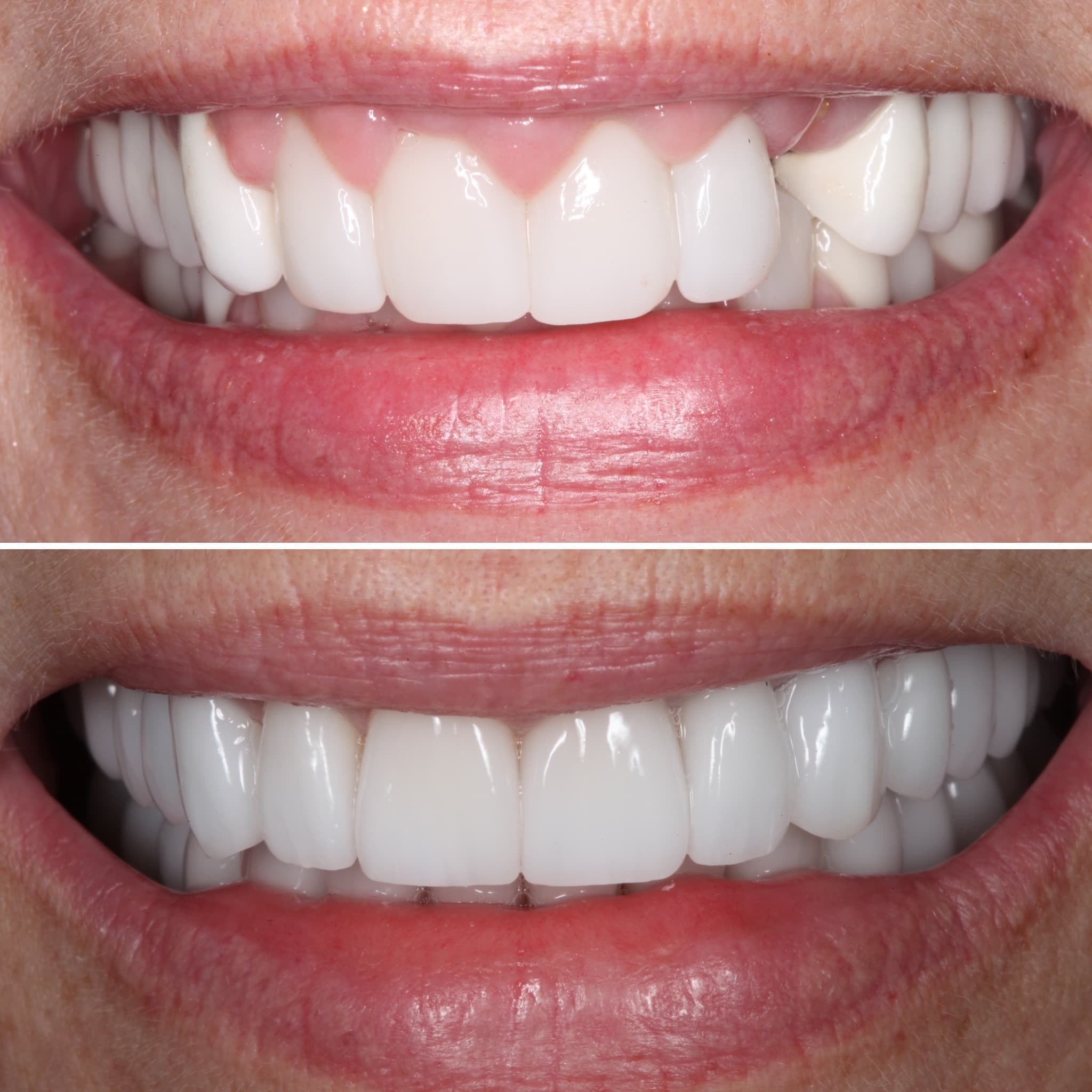 Before and after — Cosmetic & restorative dentistry — case 58 by Strupp & Brumm in Clearwater, FL