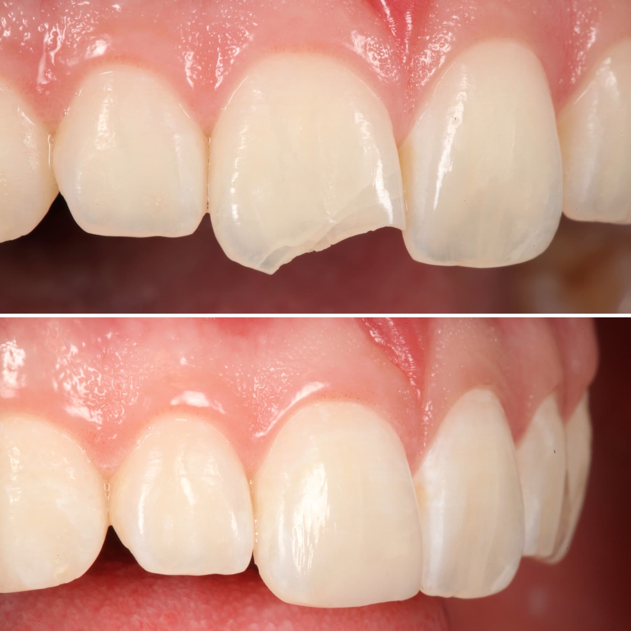 Before and after — Cosmetic & restorative dentistry — case 59 by Strupp & Brumm in Clearwater, FL
