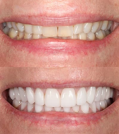 Before and after — Cosmetic & restorative dentistry — case 6 by Strupp & Brumm in Clearwater, FL