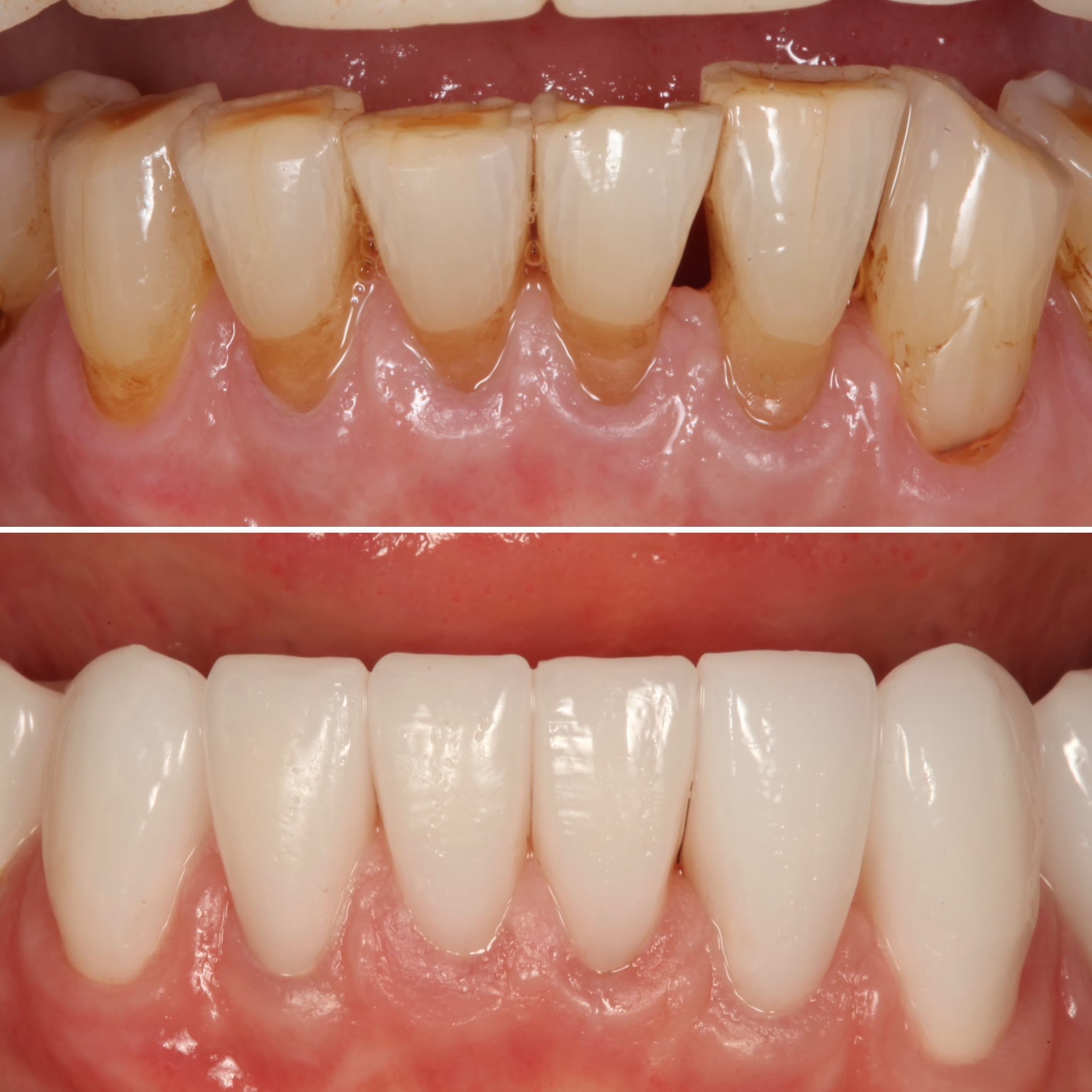 Before and after — Cosmetic & restorative dentistry — case 60 by Strupp & Brumm in Clearwater, FL