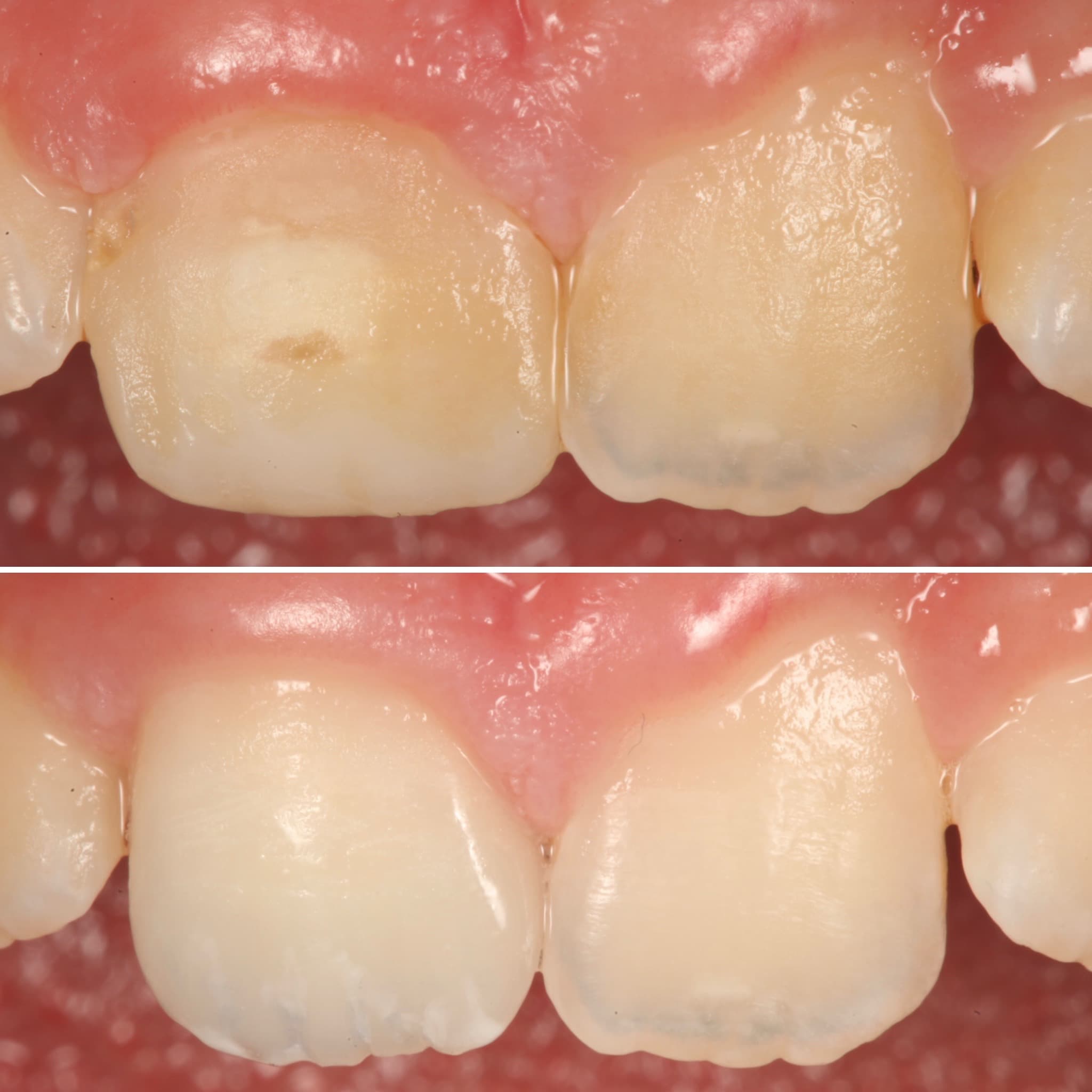 Before and after — Cosmetic & restorative dentistry — case 62 by Strupp & Brumm in Clearwater, FL