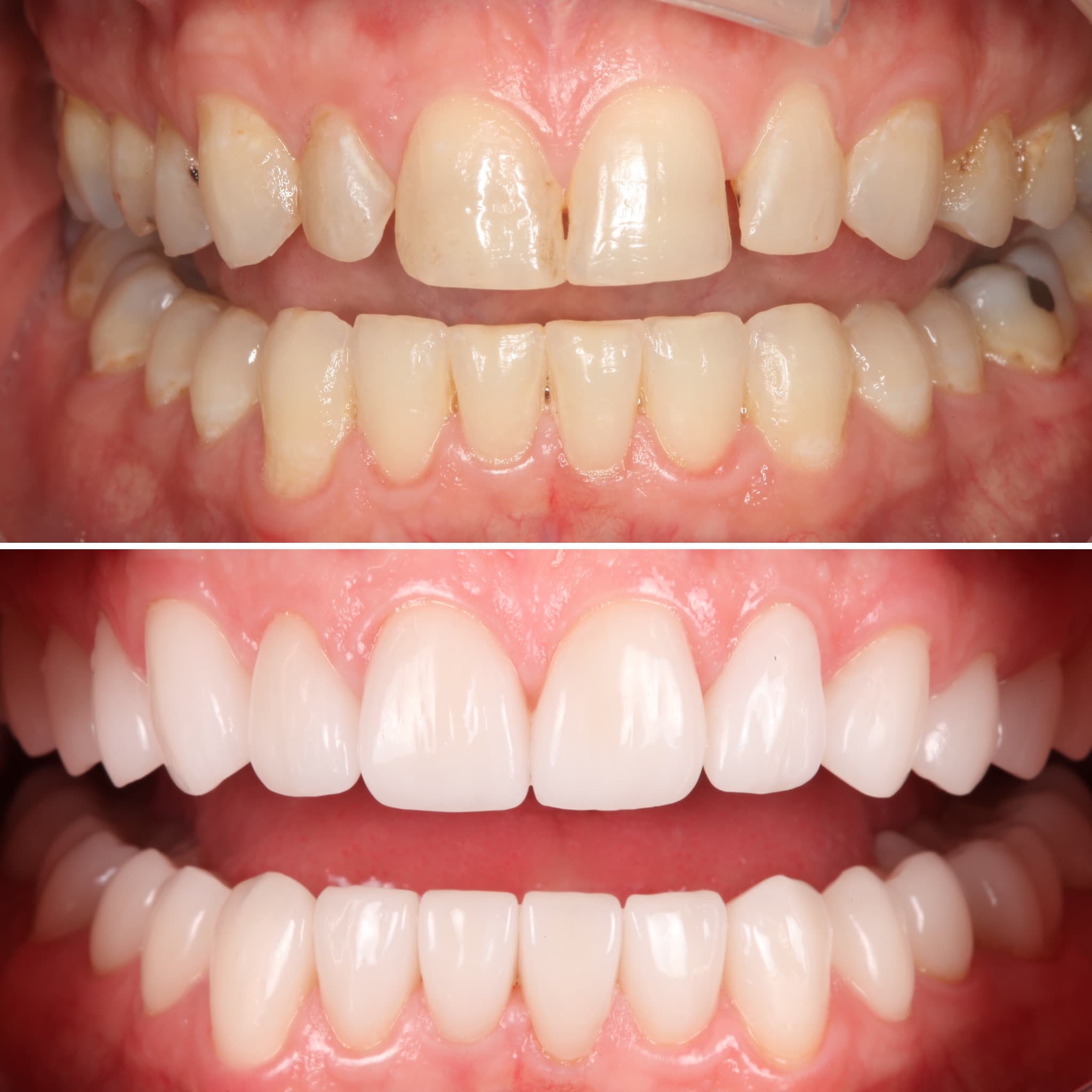 Before and after — Cosmetic & restorative dentistry — case 63 by Strupp & Brumm in Clearwater, FL