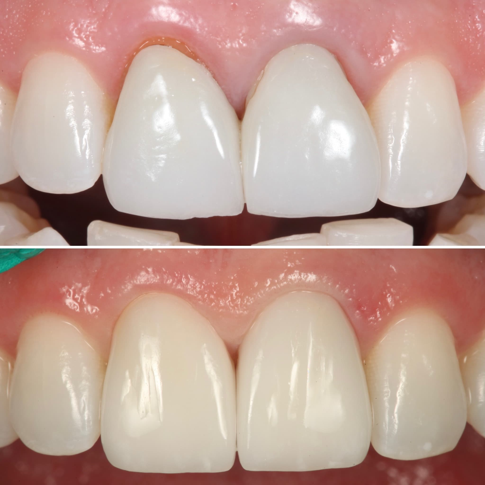 Before and after — Cosmetic & restorative dentistry — case 65 by Strupp & Brumm in Clearwater, FL