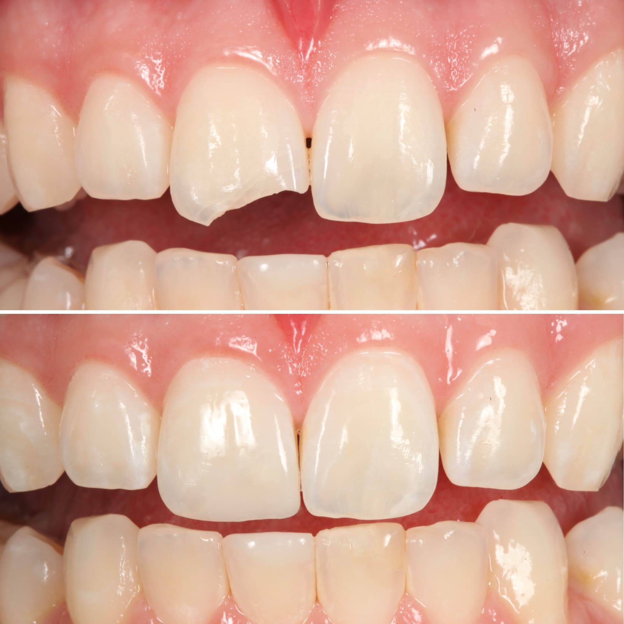Before and after — Cosmetic & restorative dentistry — case 66 by Strupp & Brumm in Clearwater, FL