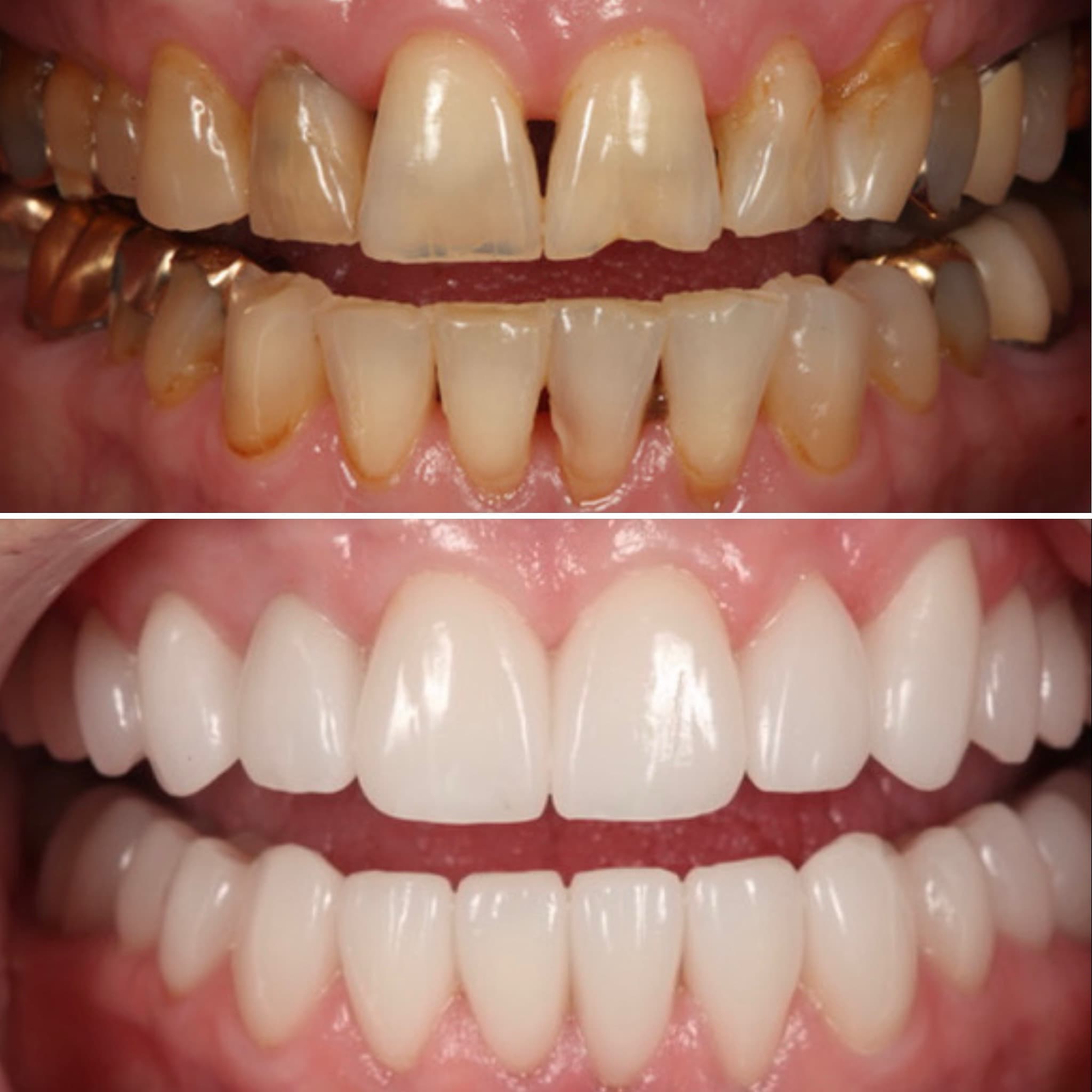 Before and after — Cosmetic & restorative dentistry — case 72 by Strupp & Brumm in Clearwater, FL