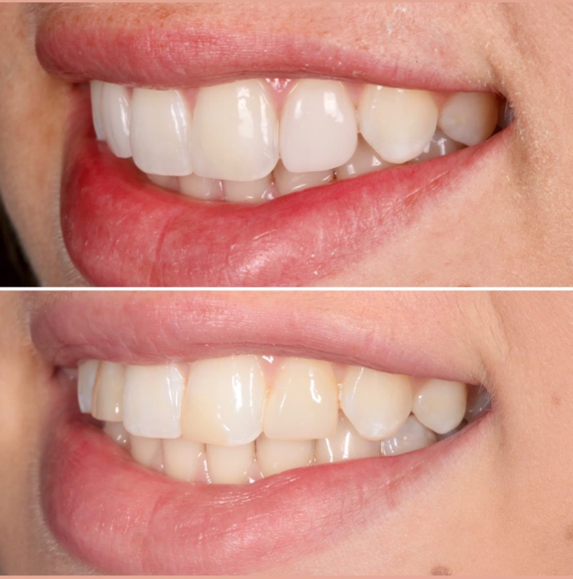 Before and after — Cosmetic & restorative dentistry — case 73 by Strupp & Brumm in Clearwater, FL
