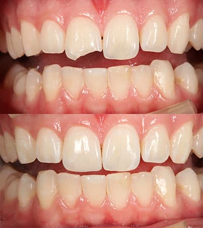 Before and after — Cosmetic & restorative dentistry — case 9 by Strupp & Brumm in Clearwater, FL