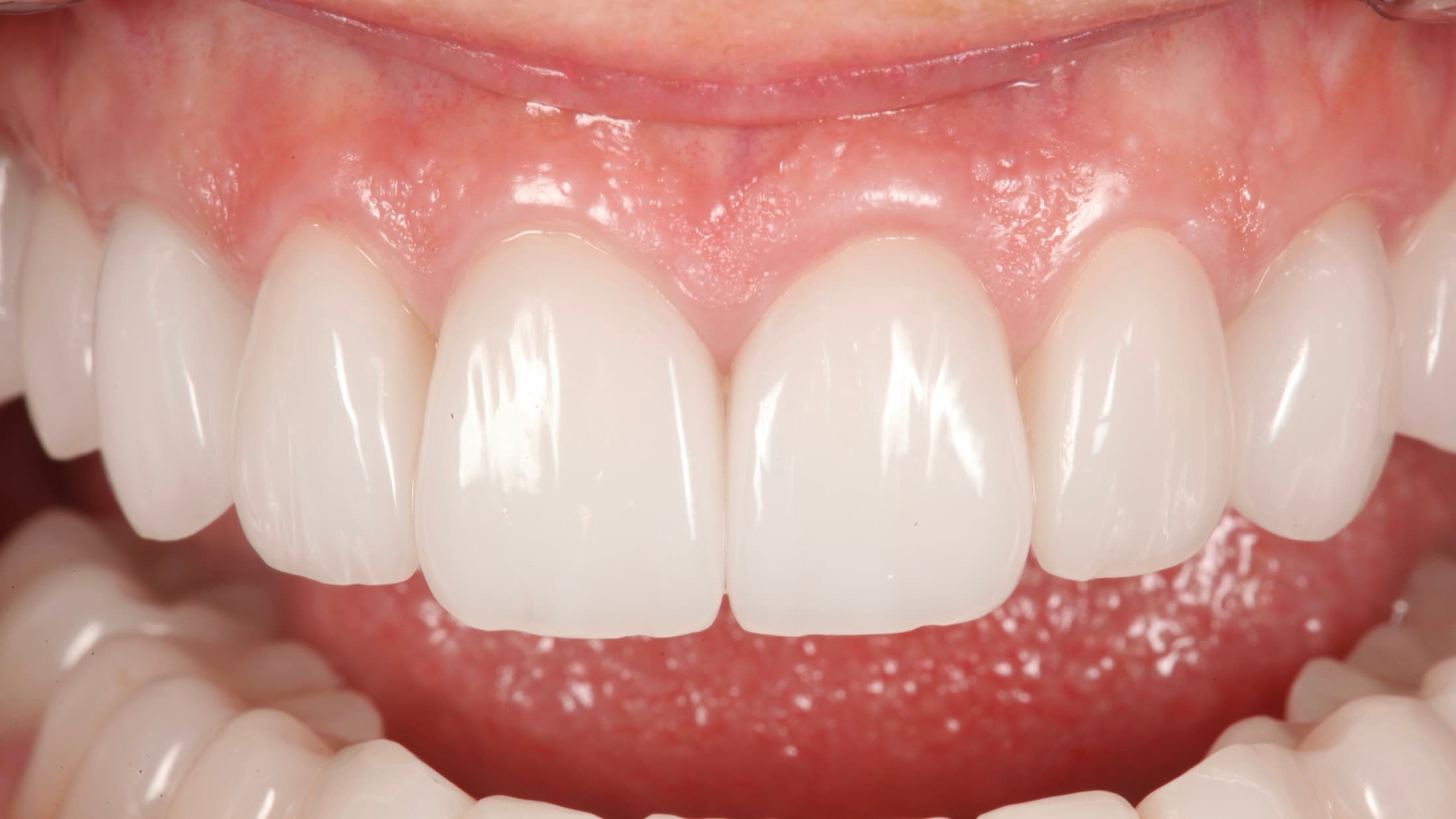Cosmetic Dentistry at Strupp & Brumm, Clearwater FL