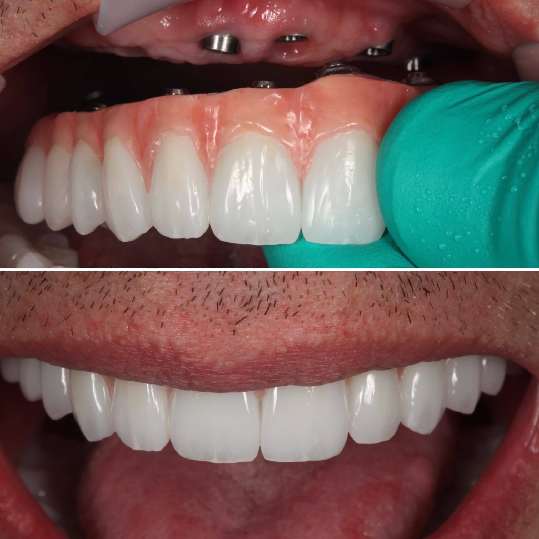Implant Hybrids (All-on-4 Alternative) at Strupp & Brumm, Clearwater FL
