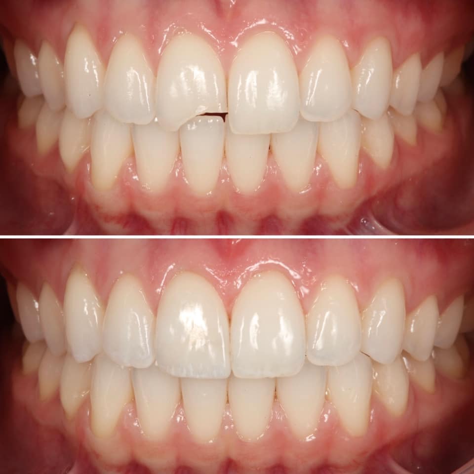 Direct composite bonding by Strupp & Brumm — before and after, Clearwater, FL