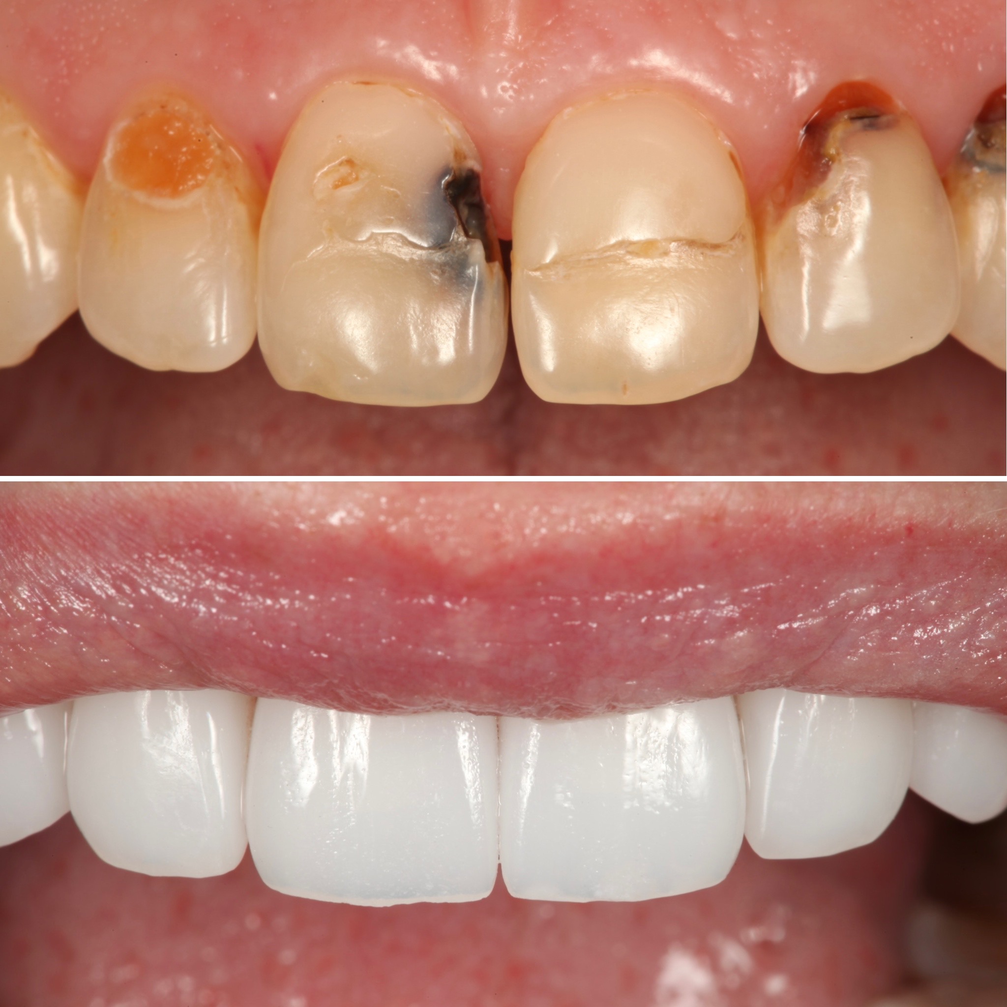 Smile rejuvenation — Strupp & Brumm cosmetic and restorative dentistry, Clearwater FL