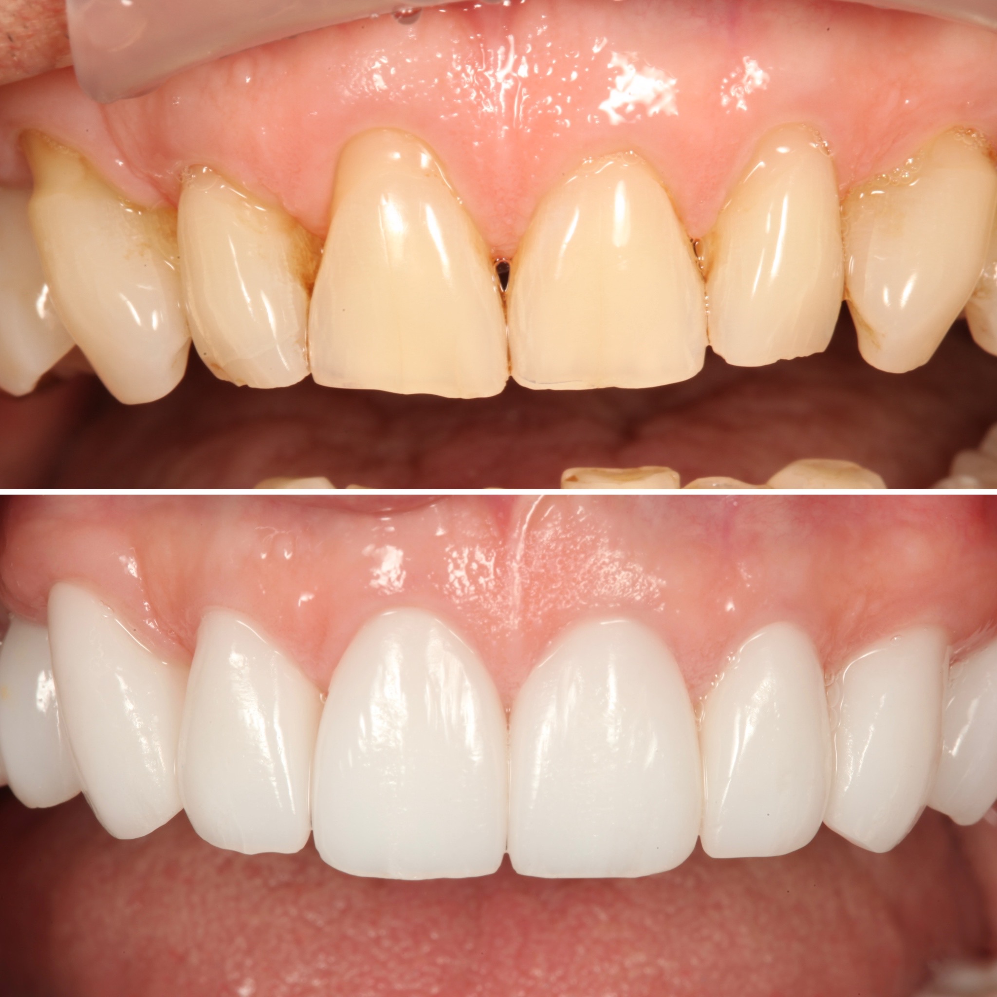 Porcelain restorations on the upper front teeth — before and after by Strupp & Brumm, Clearwater FL
