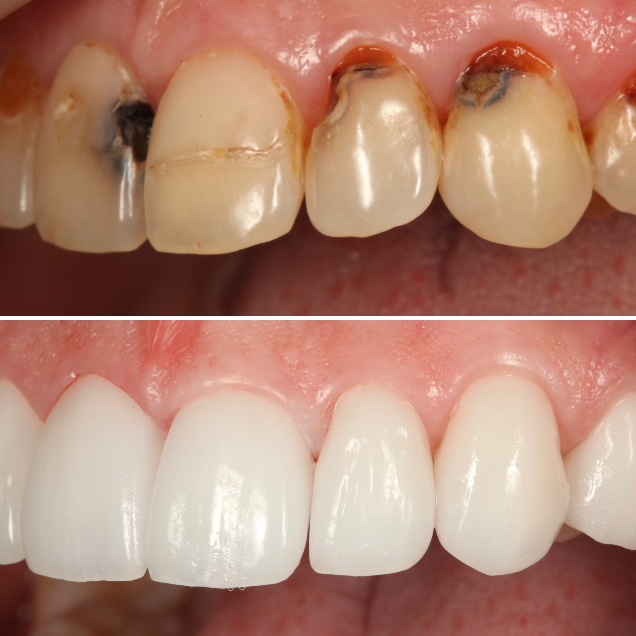 Full-mouth reconstruction — Strupp & Brumm AACD Accredited Fellows, Clearwater FL